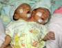 Innalillahi…bayi kembar siam berkepala dua dari gresik itu telah tiada